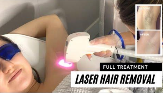 Laser Hair Removal